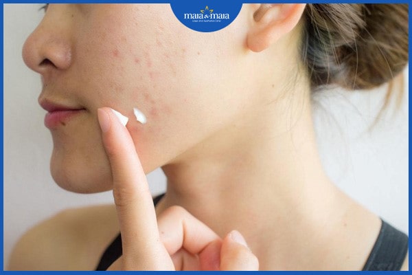 bệnh viêm nang lông ở mặt