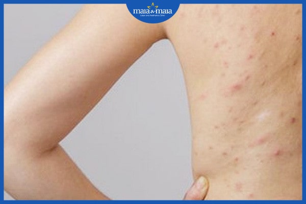 Biểu hiện của viêm nang lông