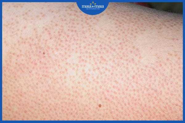 điều trị bệnh viêm nang lông