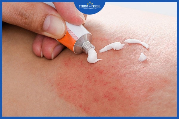 điều trị bệnh viêm nang lông