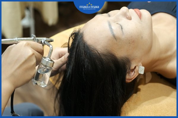 điều trị hói đầu