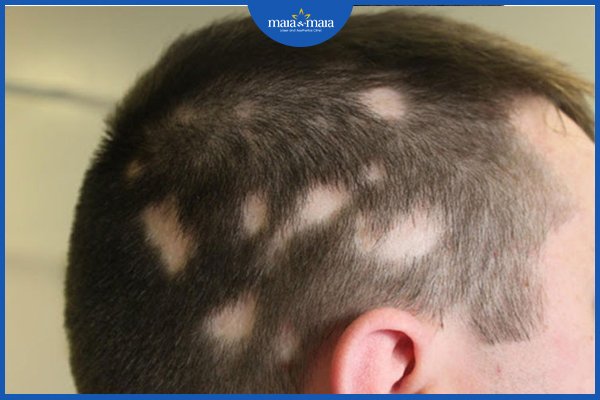 hói đầu và cách điều trị