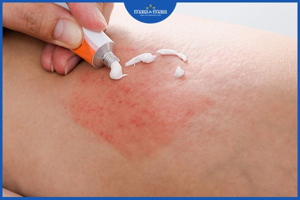 Phân biệt viêm nang lông và mụn trứng cá