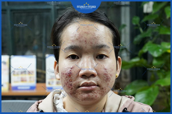 biểu hiện của mụn trứng cá