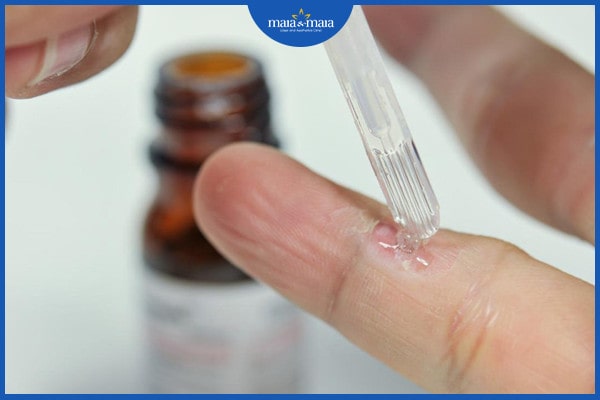 cách trị mụn cóc nhanh nhất tại nhà