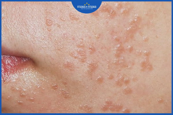 dấu hiệu của mụn cóc