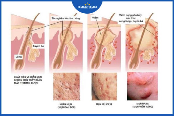 mụn trứng cá dạng nang