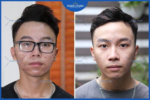 mụn trứng cá nang