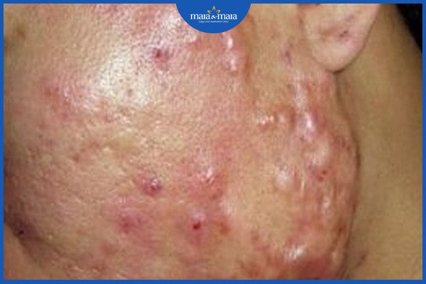 mụn trứng cá mạch lươn