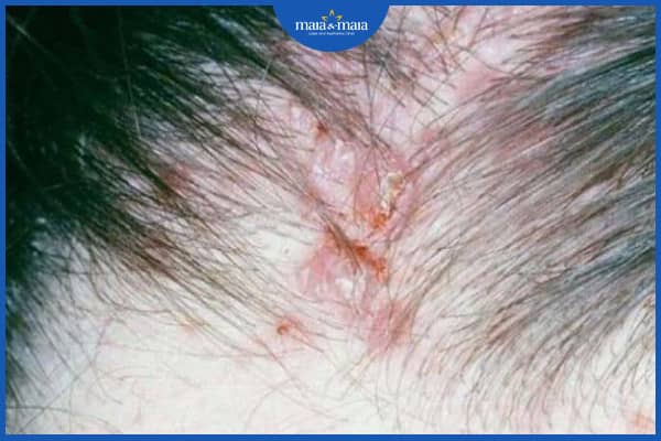 Mụn trứng cá trên da đầu