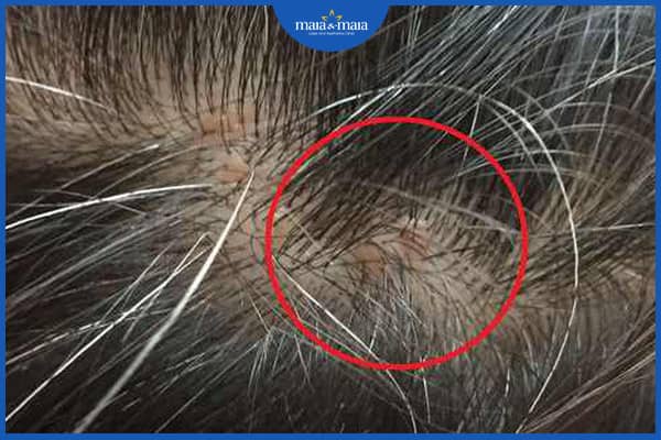 Mụn trứng cá trên da đầu