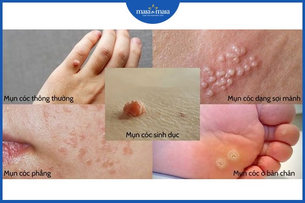 Nguyên nhân hình thành mụn cóc