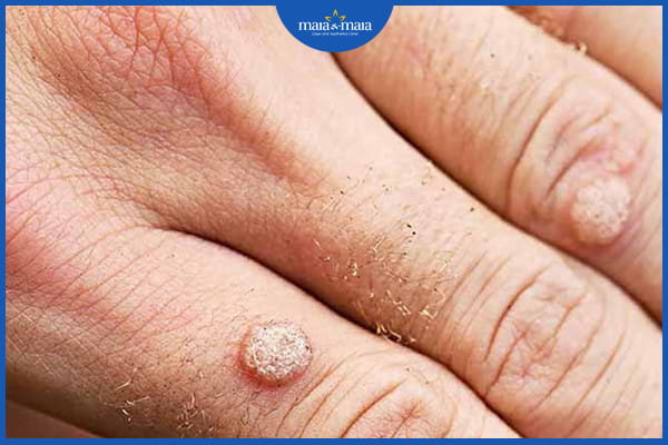 phân biệt mụn cóc và sùi mào gà