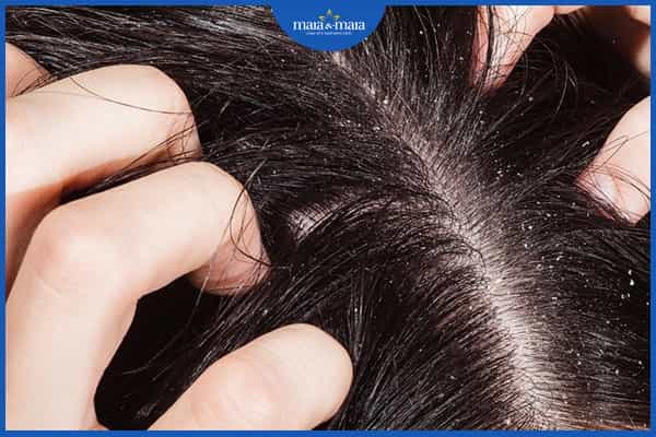 Viêm nang lông da đầu có lây không