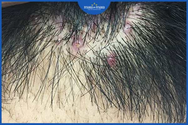 Viêm nang tóc là bệnh gì