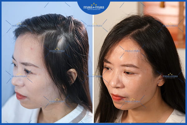 Gội đầu nhiều có rụng tóc không