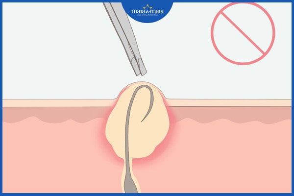 Mụn trứng cá bọc ở mũi