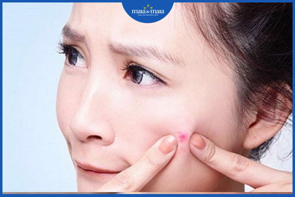 Mụn trứng cá có tự khỏi không
