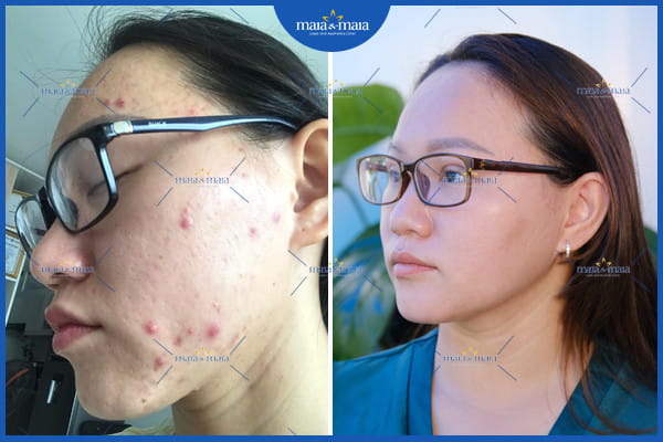 Mụn trứng cá có tự khỏi không