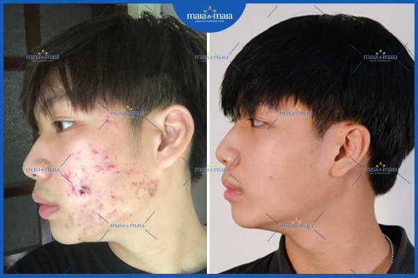Mụn trứng cá ở nam giới