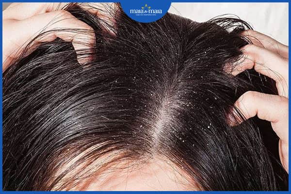 Tóc rụng có hạt trắng