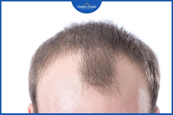 Rụng tóc có phải bị ung thư