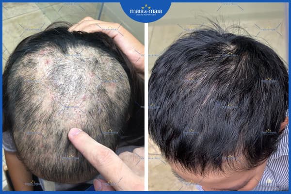 Rụng tóc có phải ung thư