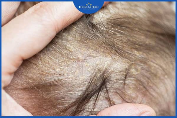 Rụng tóc khi gội đầu
