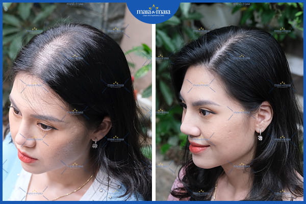 rụng tóc khi mang thai