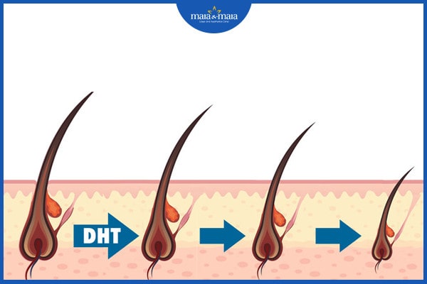 rụng tóc ở tuổi dậy thì