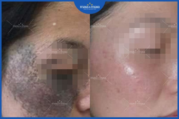 các loại bớt sắc tố