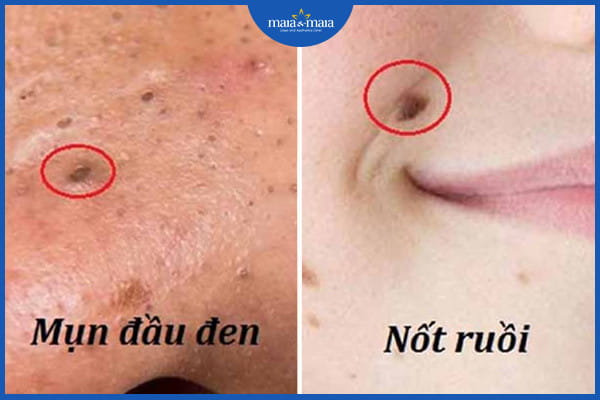 Mụn có thành nốt ruồi không
