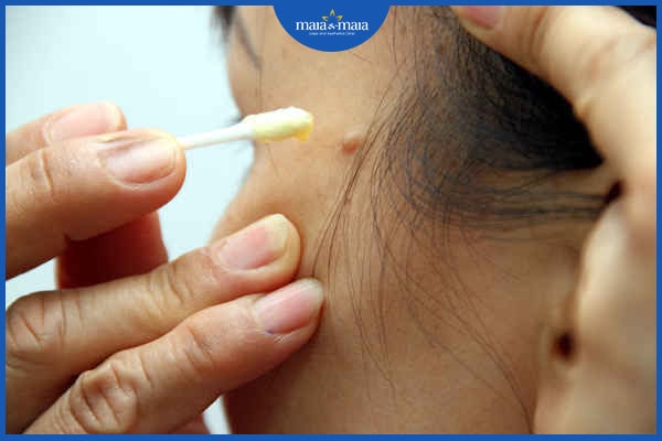 Tẩy nốt ruồi có để lại sẹo không