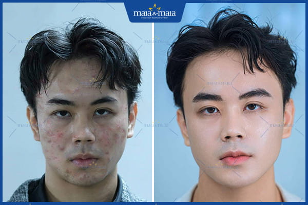 30 tuổi vẫn bị mụn