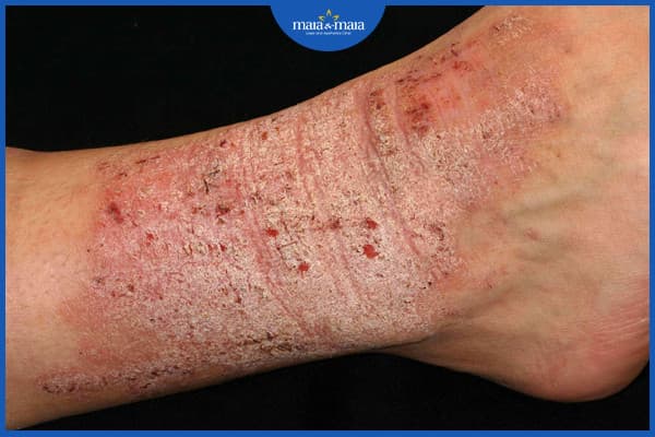 Bệnh viêm da đối xứng
