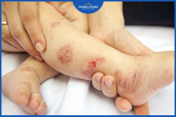biến chứng viêm da cơ địa