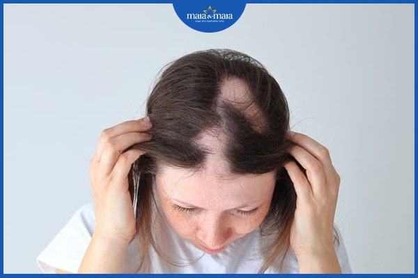 Những cách trị rụng tóc theo mảng