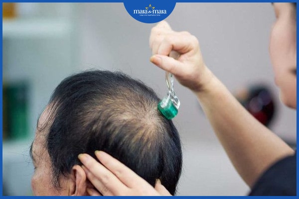 Những cách trị rụng tóc theo mảng
