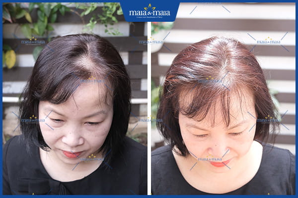 rụng tóc hỏi kiểu nữ