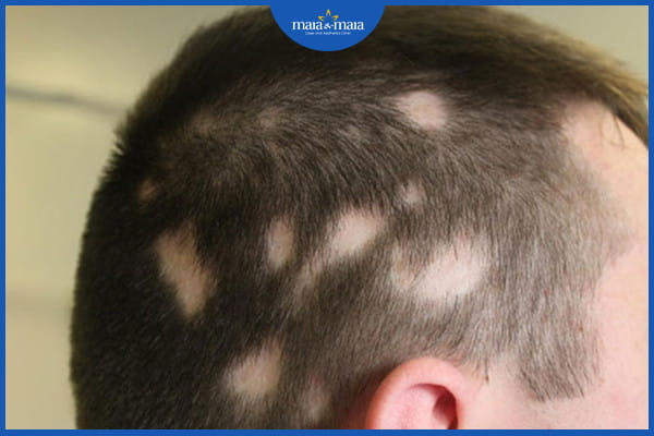tóc rụng theo mảng vào mùa đông