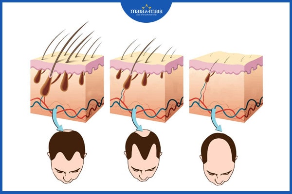tóc rụng theo mảng vào mùa đông