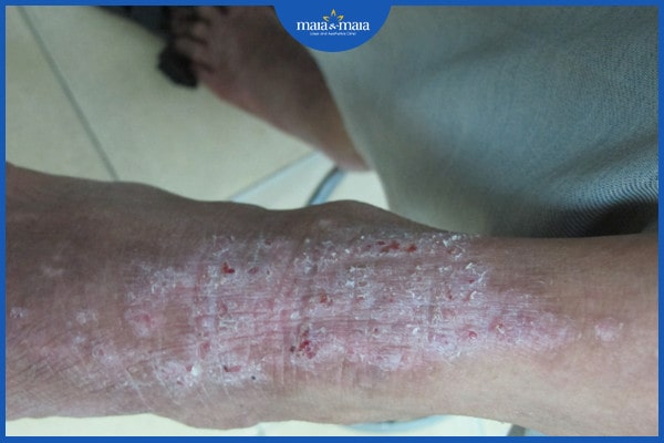viêm da cơ địa có bị lây không