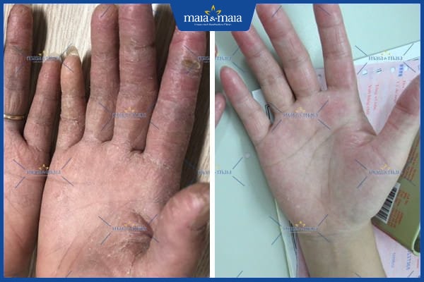 bệnh ngoài da dễ mắc vào mùa đông