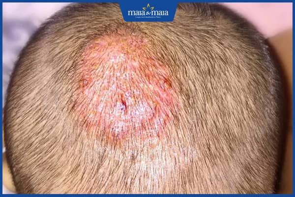 Các loại rụng tóc ở trẻ em