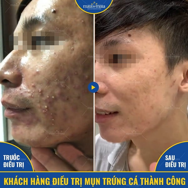 Có nên đi spa trị mụn tuổi dậy thì