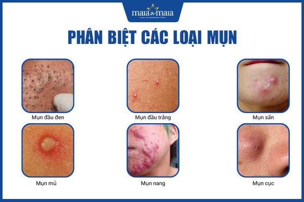 Có nên đi spa trị mụn tuổi dậy thì