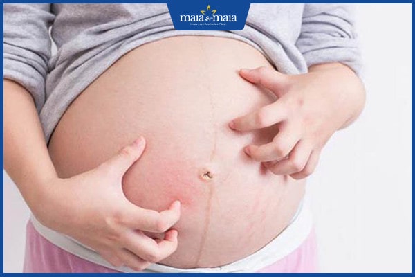 mề đay khi mang thai và sau sinh