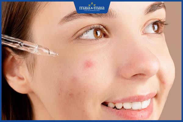 Phải làm sao để hết mụn