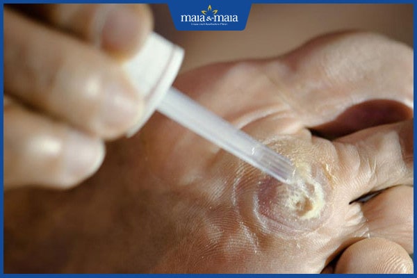 thuốc trị mụn cóc