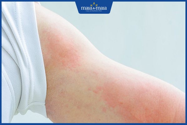 Bệnh mề đay ánh sáng mặt trời